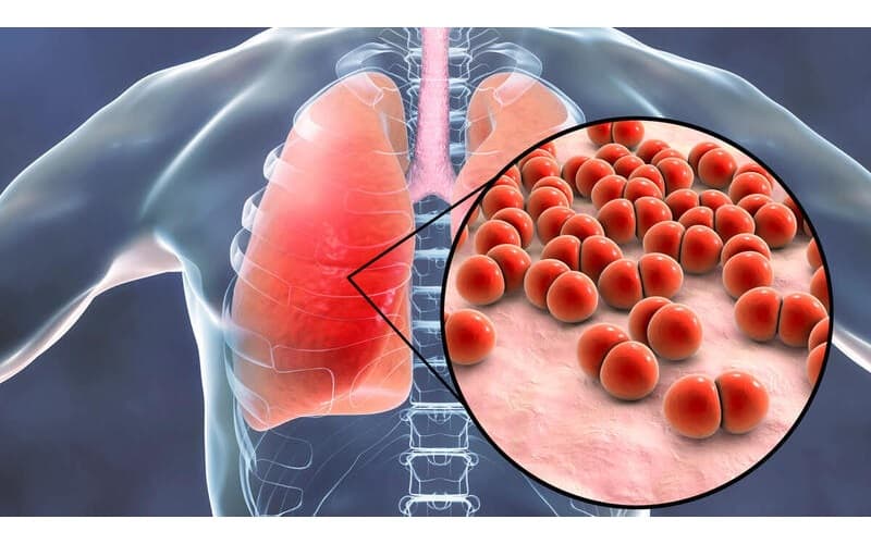 Bệnh phổi kẽ thường diễn tiến âm thầm
