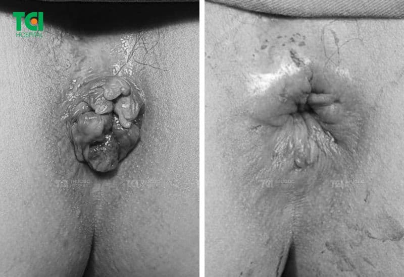 Hình ảnh hậu môn sau khi điều trị bằng đốt trĩ Laser Diode tại TCI