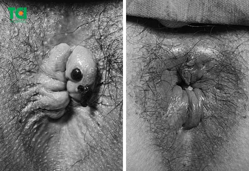 Trước - sau khi điều trị 