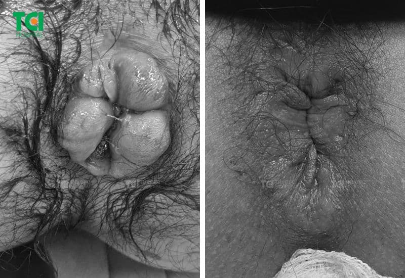 Hậu môn của bệnh nhân trĩ sau điều trị tại TCI
