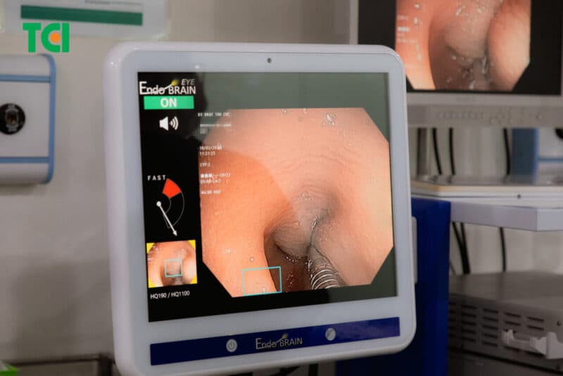 Nội soi tiêu hóa công nghệ cao giúp phát hiện sớm các tổn thương trong đó có viêm đại tràng.
