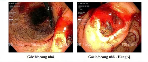 Kết quả nội soi của bà V tháng 7/2024 - Loét góc bờ cong nhỏ đang chảy máu tiêu hóa