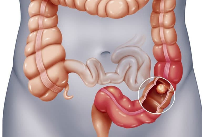Polyp đại tràng khá phổ biến hiện nay.