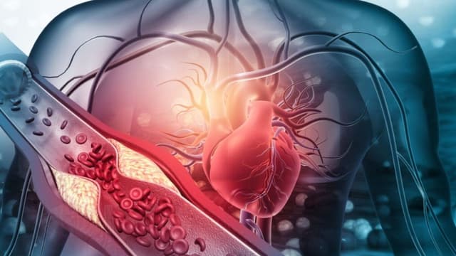 Những lầm tưởng thường gặp về bệnh động mạch vành