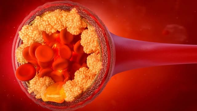 Bệnh mỡ máu có nguy hiểm không và cách kiểm soát mỡ máu