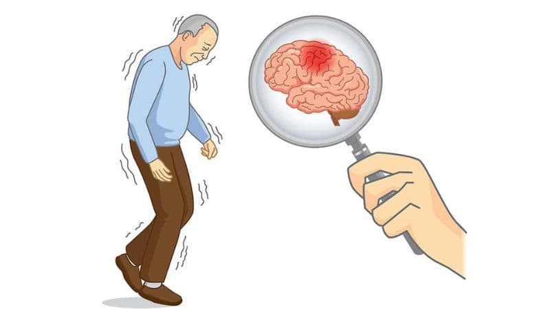 Bệnh Parkinson là gì, nguyên nhân gây bệnh