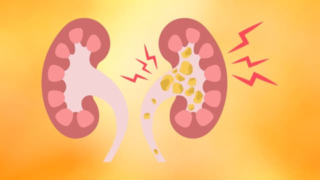 Bệnh sỏi tiết niệu mùa nắng nóng tăng cao: Lý giải nguyên nhân