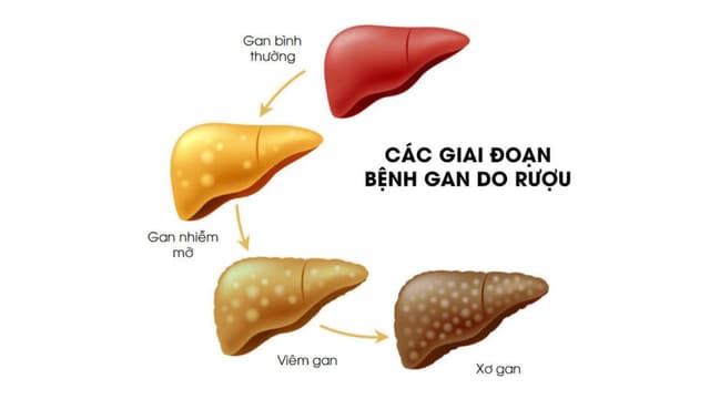 Viêm gan nhiễm mỡ: Cơ chế sinh bệnh và cách phòng ngừa