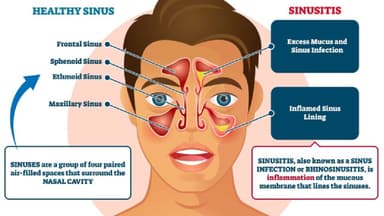 Bệnh viêm xoang mũi và cách xử lý