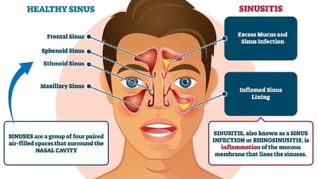 Bệnh viêm xoang mũi và cách xử lý