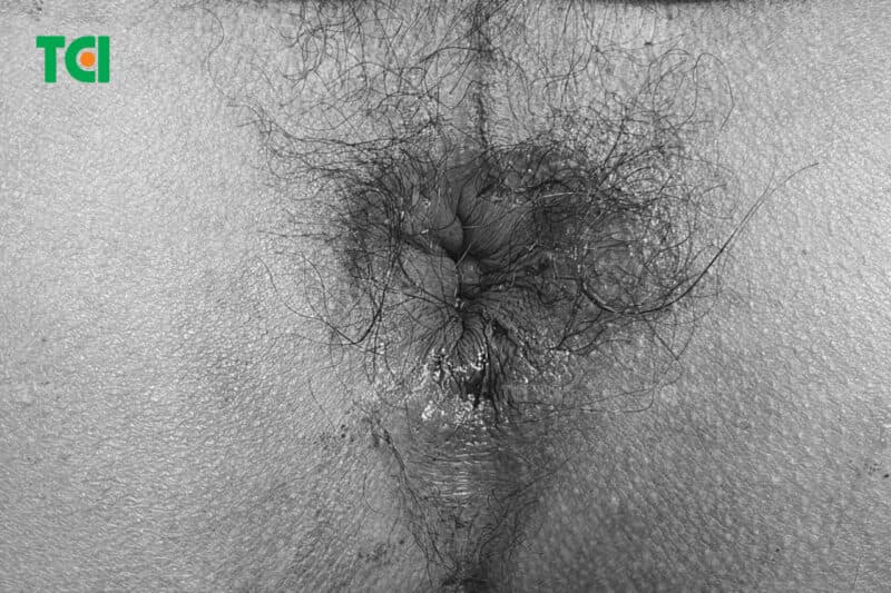 Hình ảnh hậu môn sau điều trị bằng Laser Diode