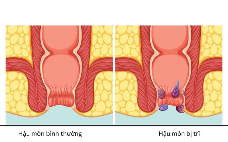 Biểu hiện trĩ nội