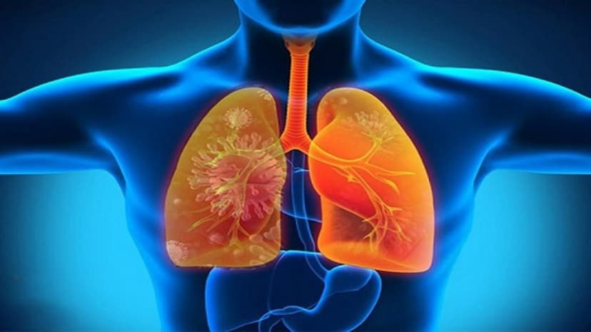 Biểu hiện viêm phổi dễ bị bỏ qua