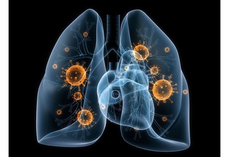 Viêm phổi là tình trạng nhiễm trùng 