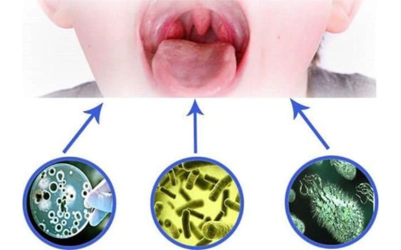 Cách chữa viêm họng đơn giản