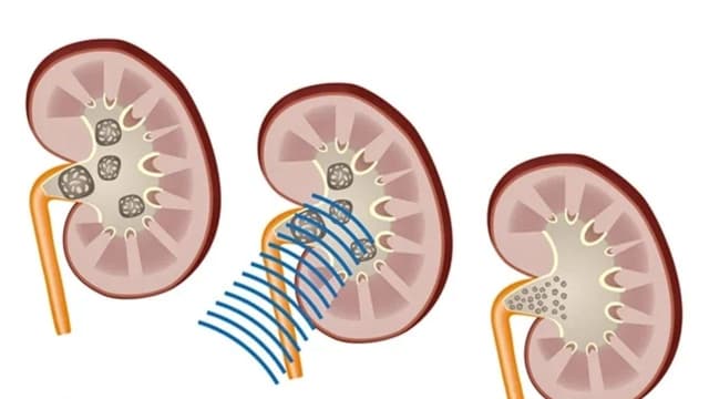 Cách điều trị sỏi tiết niệu bằng công nghệ tán sỏi hiện đại