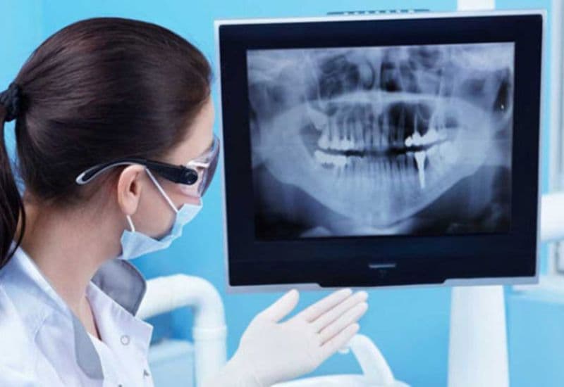 Cách nhổ răng sâu bắt đầu bằng việc bác sĩ thăm khám tổng quát và chụp X-quang để xác định mức độ tổn thương của răng.