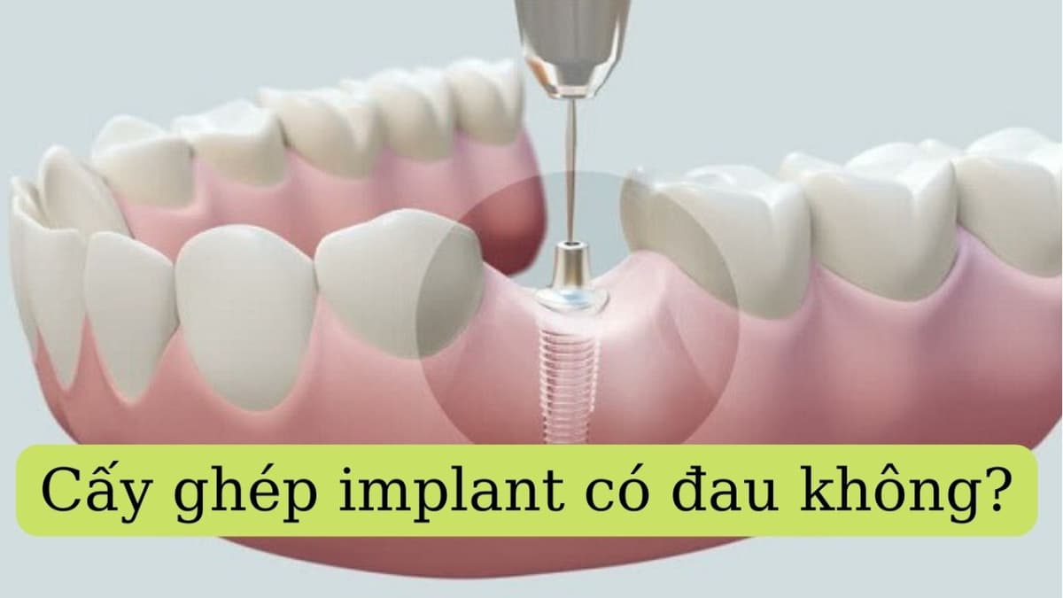 Cấy ghép răng implant có đau không – Tìm hiểu trước khi thực hiện