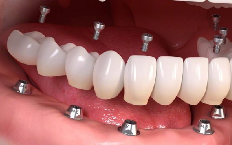 Cấy ghép răng implant có đau không vậy