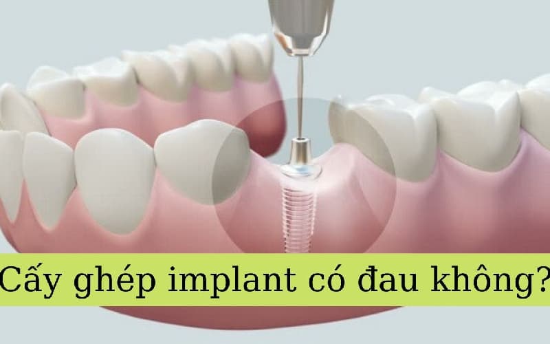 Cấy ghép răng implant có đau không hiện nay