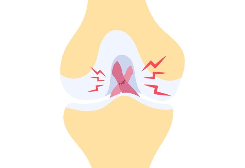 Các dạng tổn thương phổ biến ở các dây chằng khớp gối