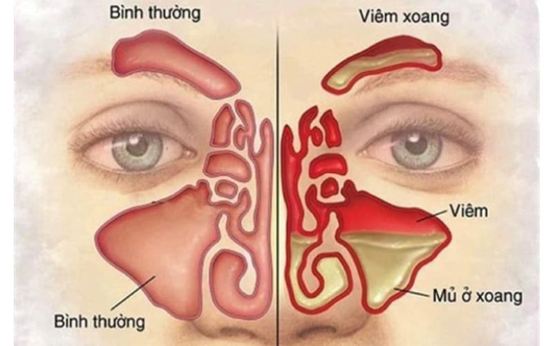 Chữa bệnh xoang đơn giản