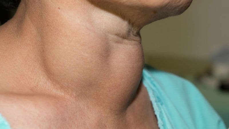 Cường giáp và bướu cổ là gì