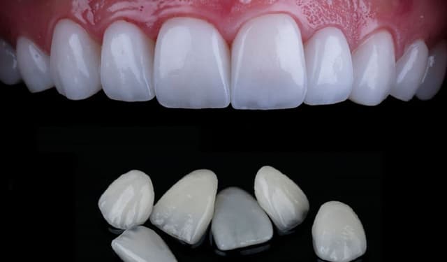 8 Lợi ích vượt trội của dán sứ veneer trong việc phục hồi hàm răng