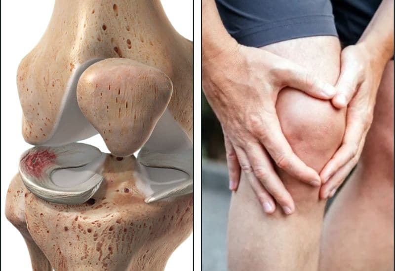 Top 5 dấu hiệu rách sụn chêm dễ bị bỏ qua