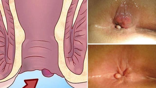 Cảnh giác với các dấu hiệu bệnh trĩ ngoại