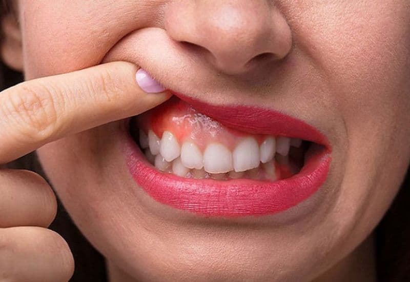 Đau nướu không chỉ gây khó chịu mà còn tiềm ẩn nhiều nguy cơ cho sức khỏe.