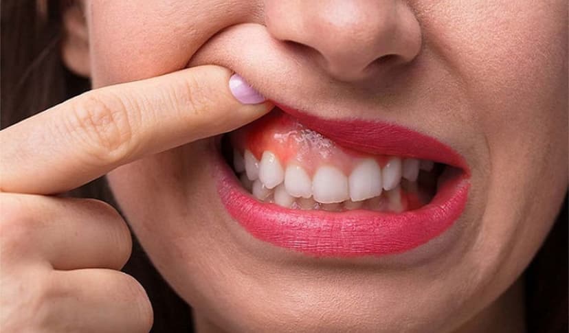 Nguyên nhân và cách điều trị đau nướu hiệu quả