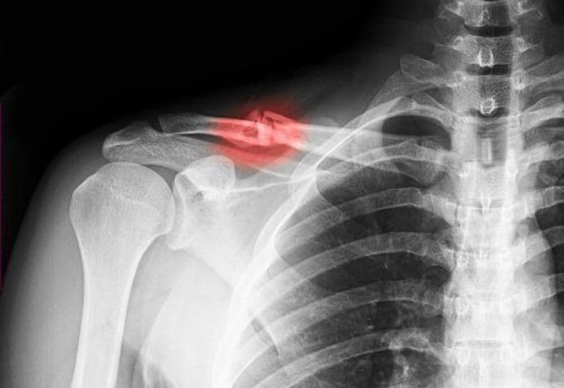 Không phải tất cả các trường hợp gãy xương đòn đều cần can thiệp phẫu thuật
