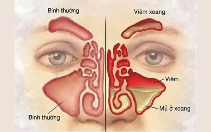 Điều trị viêm xoang cấp dễ dàng