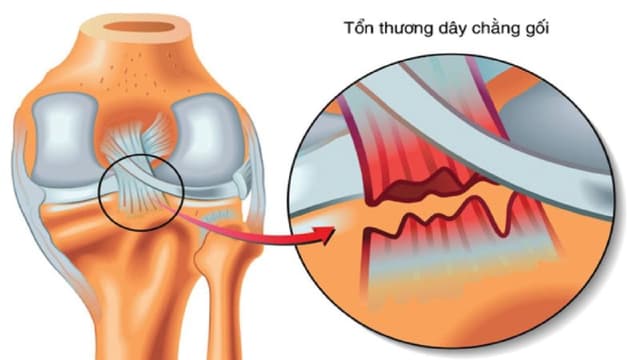 Đứt dây chằng chéo khớp gối: Chẩn đoán và điều trị