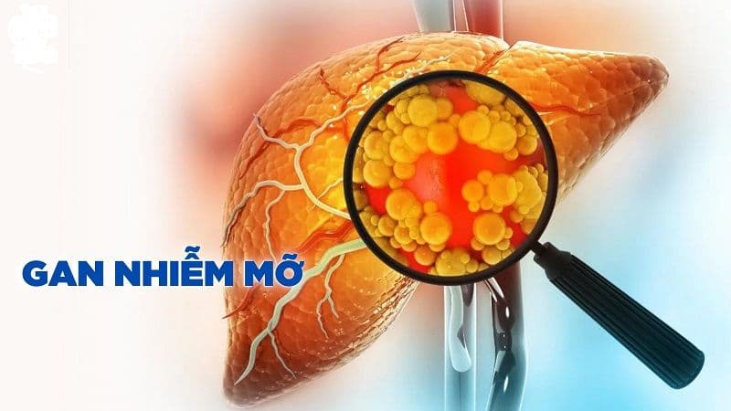 Gan nhiễm mỡ có các cấp độ nào?