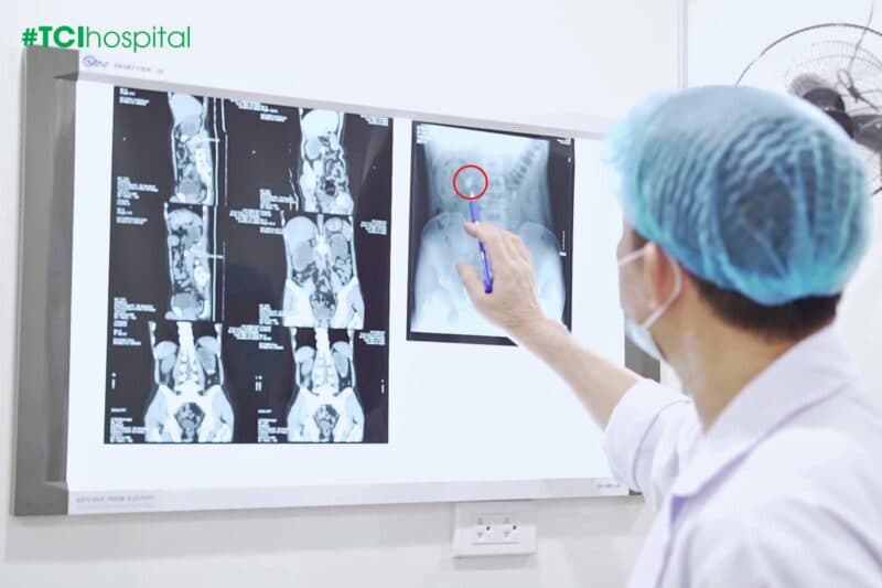 Cứu hai quả thận khỏi “bờ vực” suy thận từ biến chứng giãn nặng