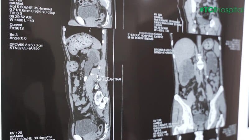 Cứu hai quả thận khỏi “bờ vực” suy thận từ biến chứng giãn nặng