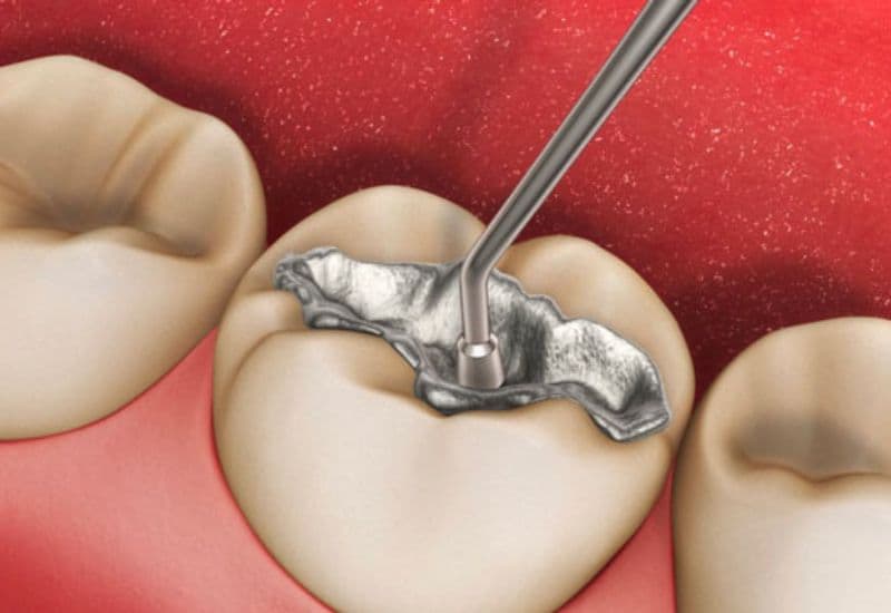 Hàn răng nứt giúp ngăn chặn hư tổn, giữ vững sức khỏe răng miệng