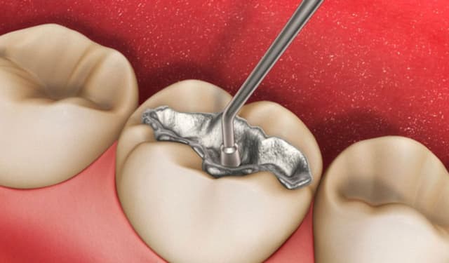 7 Lợi ích không ngờ của việc hàn răng nứt đúng thời điểm