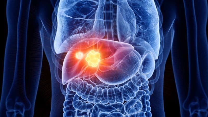 Hậu quả của tình trạng xơ hóa gan