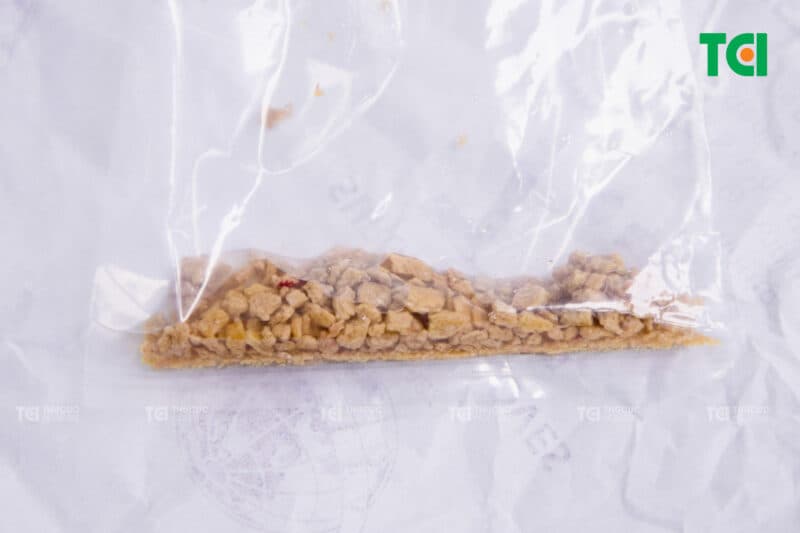 Ưu điểm nổi bật của tán sỏi thận qua da