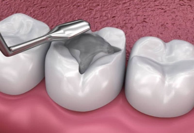 Trám răng là lựa chọn hàng đầu giúp khắc phục sâu răng nhanh chóng và hiệu quả.