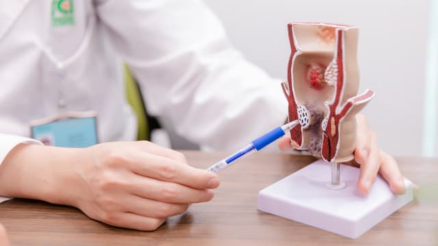 Giải đáp: Làm sao để điều trị trĩ nội hiệu quả?