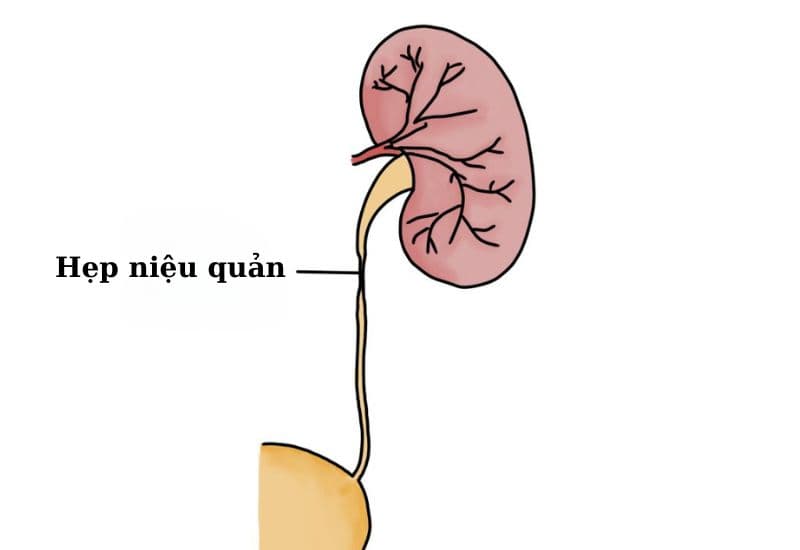 Các yếu tố nguy cơ tiềm ẩn dẫn đến đài bể thận giãn độ 3