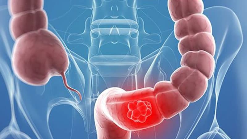 Đau đại tràng là tình trạng khá phổ biến hiện nay.