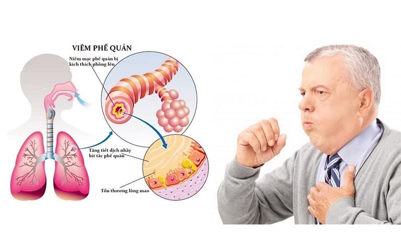 Viêm phổi ở người lớn 
