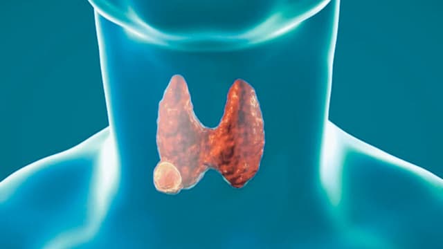 Nhân giáp lành tính là gì? Dấu hiệu nhận biết và khi nào cần khám