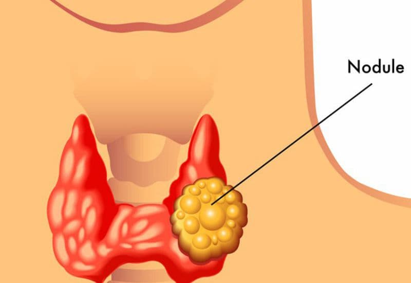Nhân giáp lành tính là gì?