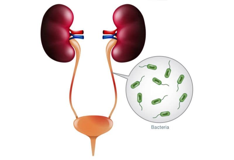 Các nhóm nguyên nhân giãn đài bể thận thường gặp